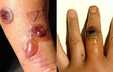 辽宁现炭疽病疫情图解皮肤炭疽感染途径与救治