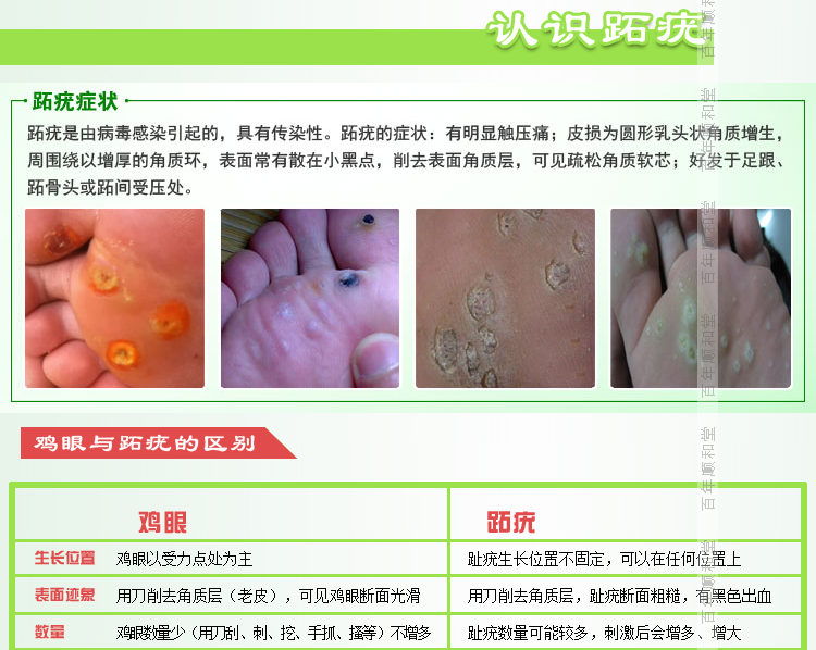 顺和堂跖疣特效药跖疣膏趾疣扁平疣甲周疣瘊子只需一次祛除淘宝网