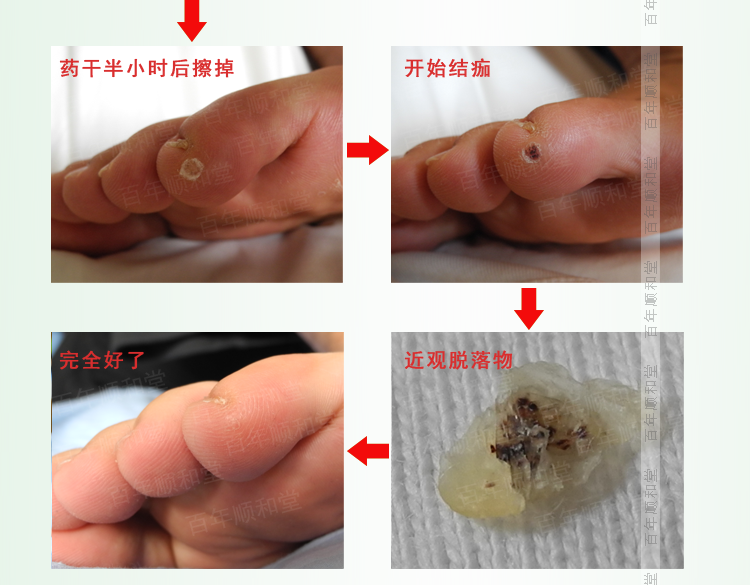 順和堂蹠疣特效藥蹠疣膏趾疣扁平疣甲周疣瘊子只需一次祛除淘寶網