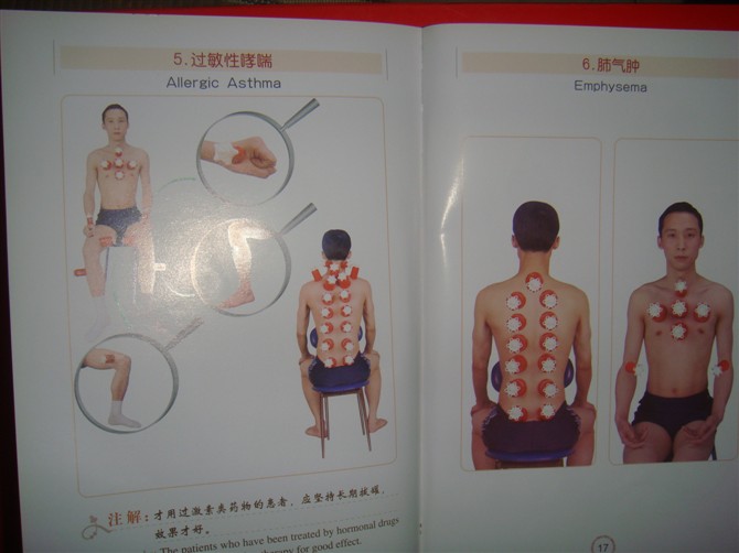 拔罐图解一看就会感冒胆囊炎便秘头痛肩周炎腰捶间盘突出关节炎