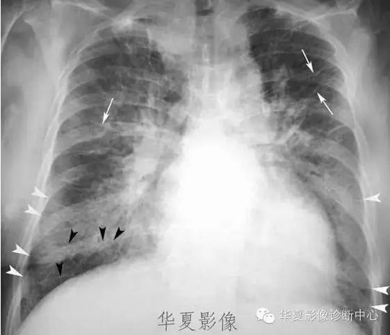 一图看清k氏abc线