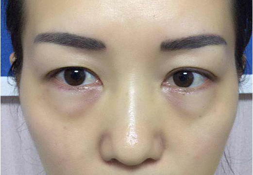 真没想到这东西既然是眼袋的克星只用了2次就治好了十年的眼袋一点