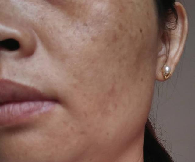内失调型黄褐斑治愈案例,皮肤疾病研究者说出2个淡斑处方