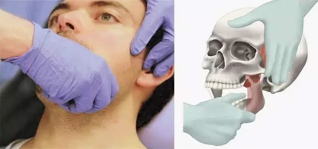 下颌关节脱位掉下巴复位手法