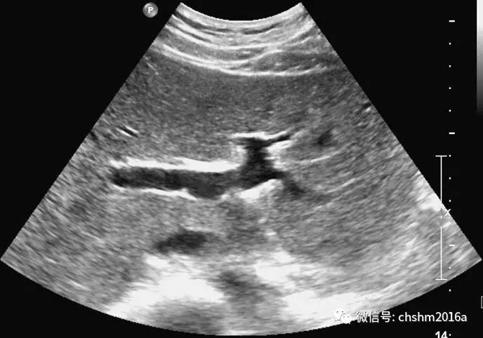 肝脏第一肝门超声图像图片