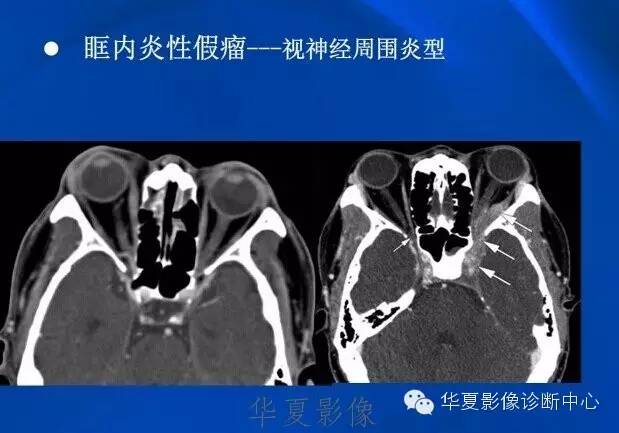 眼眶炎性假瘤的影像学诊断