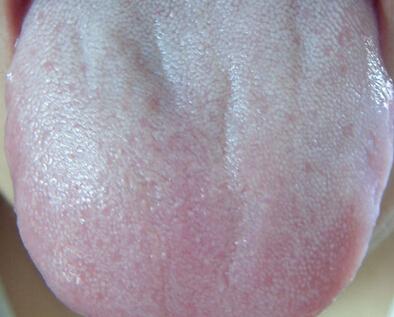 舌苔胖大有齿痕是身体什么信号