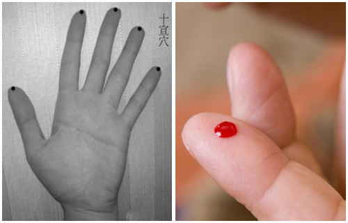 手指放血的位置示意图图片