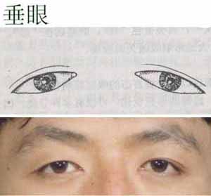 18,三角眼:一般眦角多正常,主要由于上睑皮肤中外侧松弛下垂,外眦角被