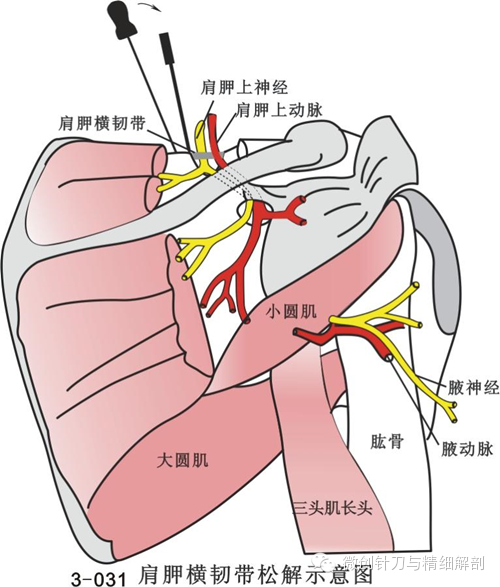 肩胛上神经卡压综合征的针刀微创治疗