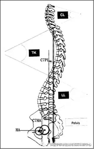 脊柱側彎矢狀面的重要性脊柱骨盆的參數