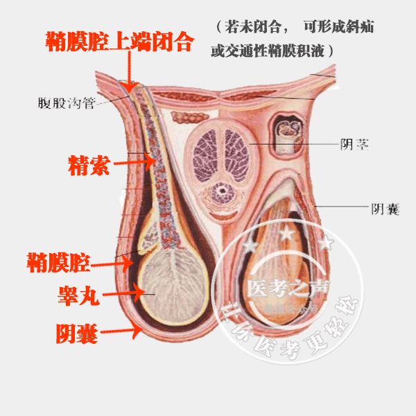 斜疝掉入睾丸,睾丸会增大鞘膜积液也可以导致睾丸增大那怎么鉴别呢?