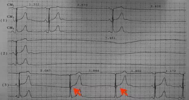 知识全解病态窦房结综合征