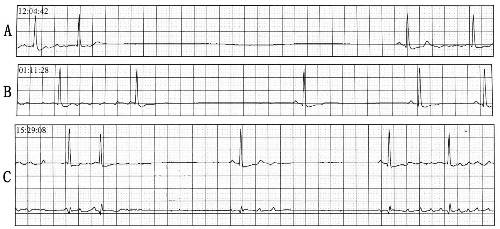 知识全解病态窦房结综合征