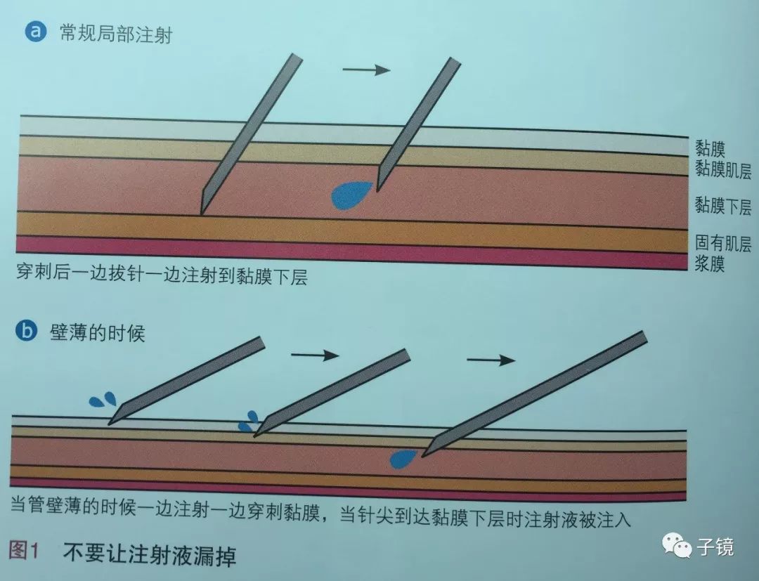 内镜技术宝典之——《大圃流esd手术技巧》学习笔记