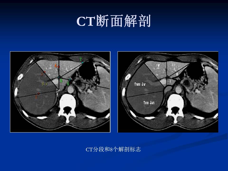 肝脏ct断层解剖图谱图片