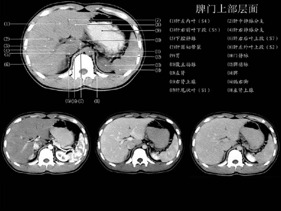 肝脏的8个分段图ct图片