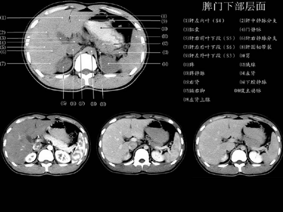 肝分叶解剖图ct图片