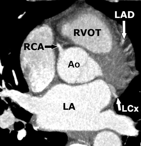 冠状动脉 coronary arteries: branches