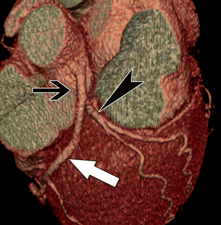 main coronary arteries include:右冠状动脉 right coronary artery