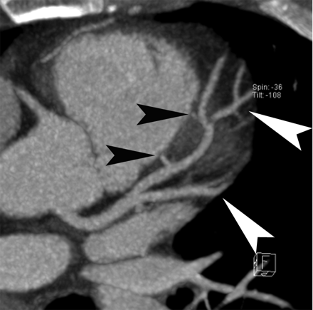 main coronary arteries include:右冠状动脉 right coronary artery