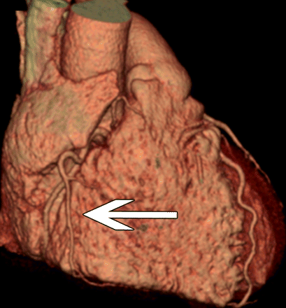 main coronary arteries include:右冠状动脉 right coronary artery