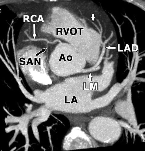 main coronary arteries include:右冠状动脉 right coronary artery