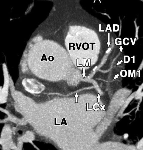 冠状动脉 coronary arteries: branches