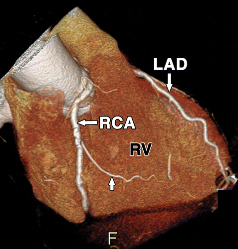 冠状动脉 coronary arteries: branches