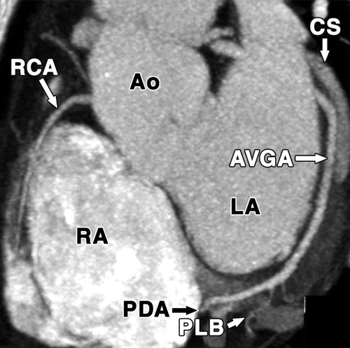 冠状动脉 coronary arteries: branches
