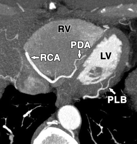 冠状动脉 coronary arteries: branches