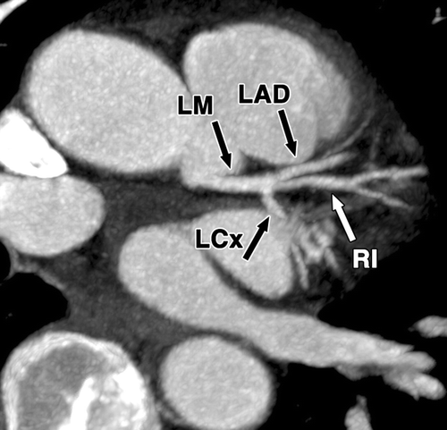 main coronary arteries include:右冠状动脉 right coronary artery