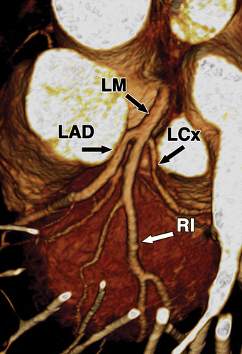main coronary arteries include:右冠状动脉 right coronary artery