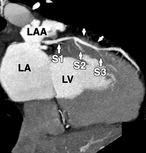 main coronary arteries include:右冠状动脉 right coronary artery