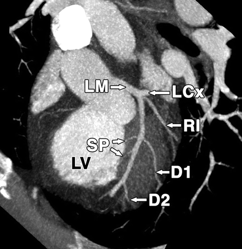 main coronary arteries include:右冠状动脉 right coronary artery