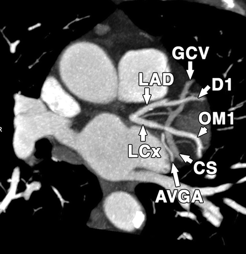 that extend from the main coronary arteries include:右冠狀動脈