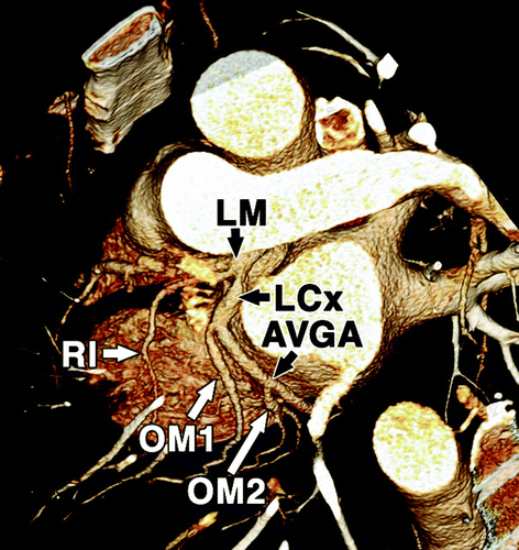 main coronary arteries include:右冠状动脉 right coronary artery