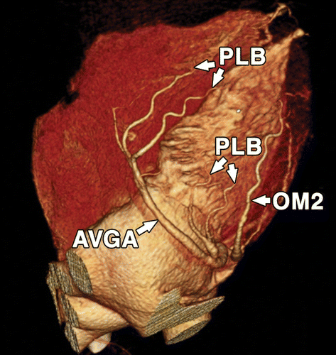 冠状动脉 coronary arteries: branches