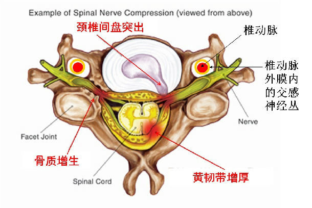 人体会代偿性的发生颈椎间关节(钩椎关节),黄韧带增生,进而压迫神经
