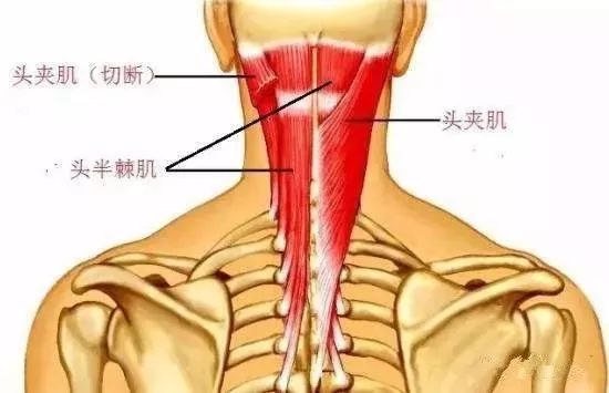 头半棘肌的五个治疗点你清楚么竖脊肌损伤之头半棘肌与颈半棘肌的针刀