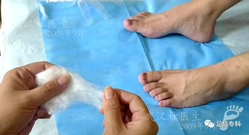 图说塞棉花甲沟炎的治疗