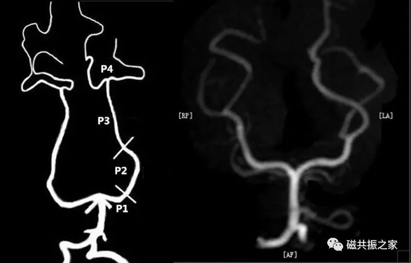 大脑后动脉分为4段:p1交通前段:由起始到中脑腹侧,许多中央小动脉由此