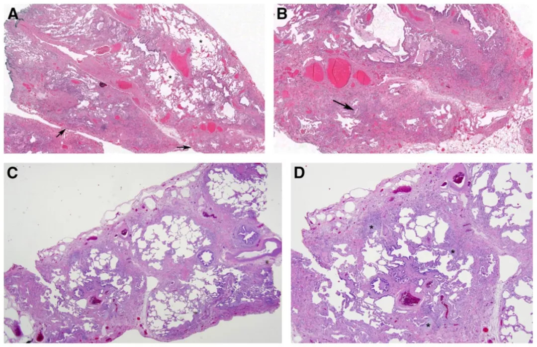 时隔7年特发性肺纤维化诊断指南首次更新atsersjrsalat官方联合发布