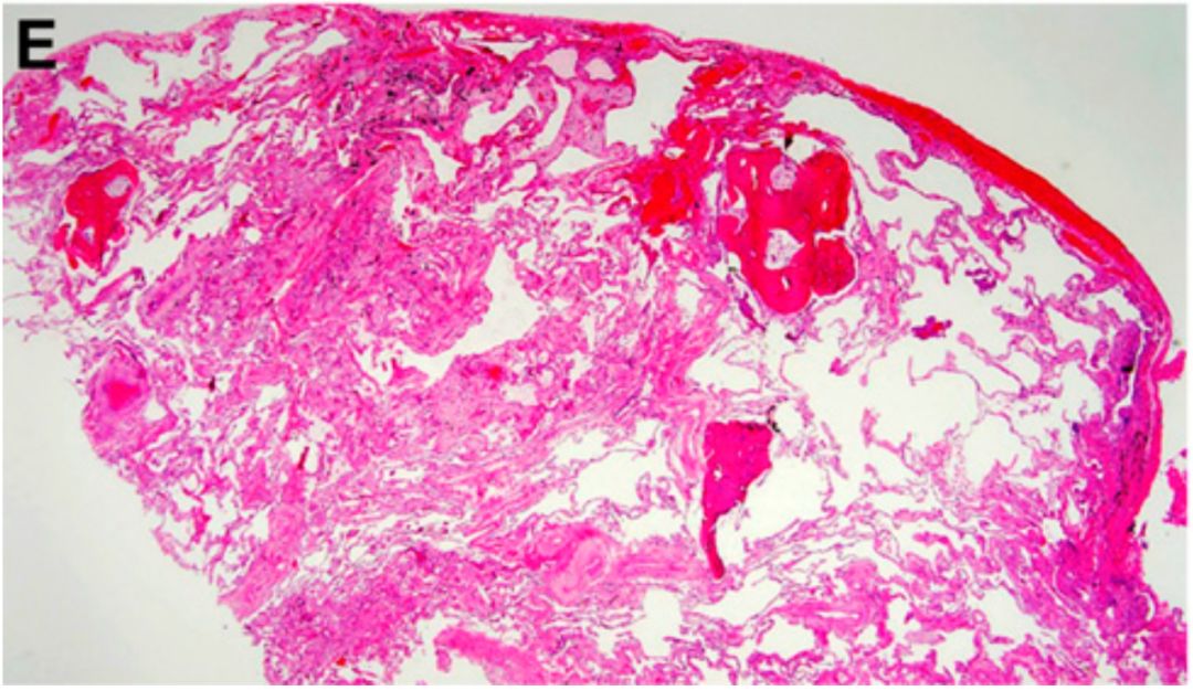 时隔7年特发性肺纤维化诊断指南首次更新atsersjrsalat官方联合发布