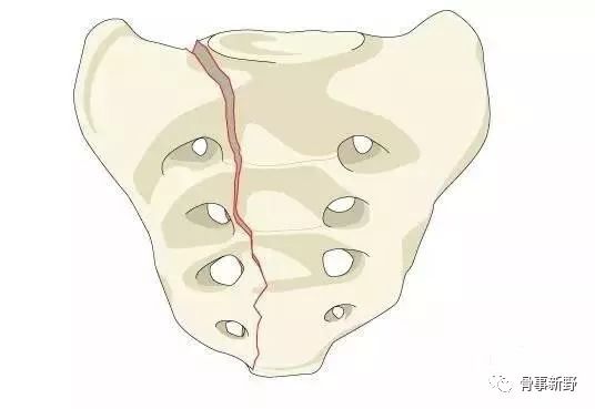 常合并神经损伤)a2型骶1以下无移位的横行骨折a1型骶骨或尾骨压缩骨折