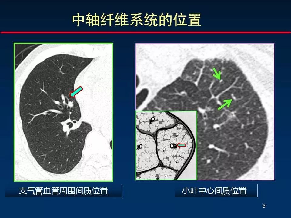 正确判读肺间质改变的基本ct表现