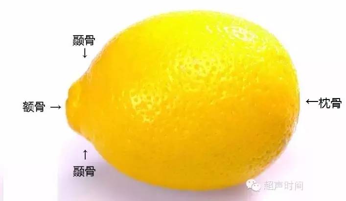 胎儿颅骨形状异常之柠檬头和草莓头