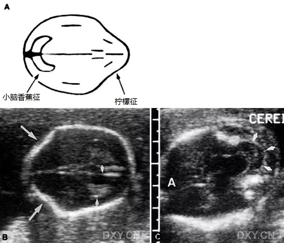 胎儿颅骨形状异常之柠檬头和草莓头