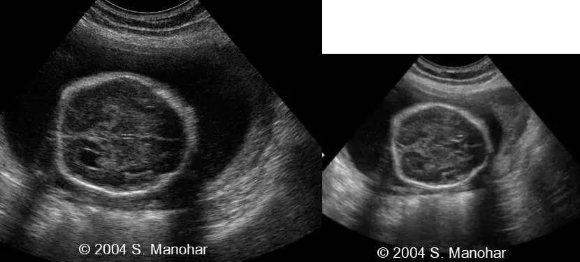 胎儿颅骨形状异常之柠檬头和草莓头