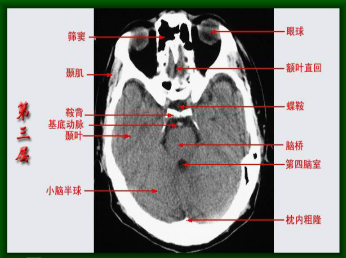 头颅ct断层解剖图片